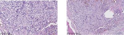 Rapid Response to the Combination of Lenvatinib and Sintilimab in a Pancreatic Acinar Cell Carcinoma Patient With Elevated Alpha-Fetoprotein: A Case Report